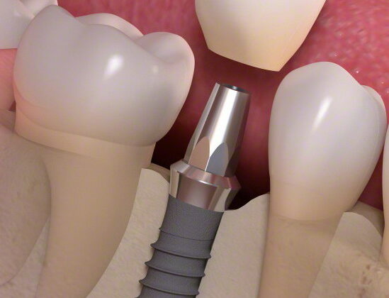 bifosfonatos e implantes dentales