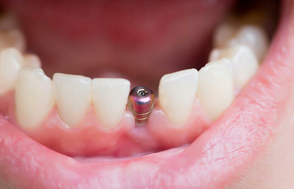 problemas con los implantes dentales