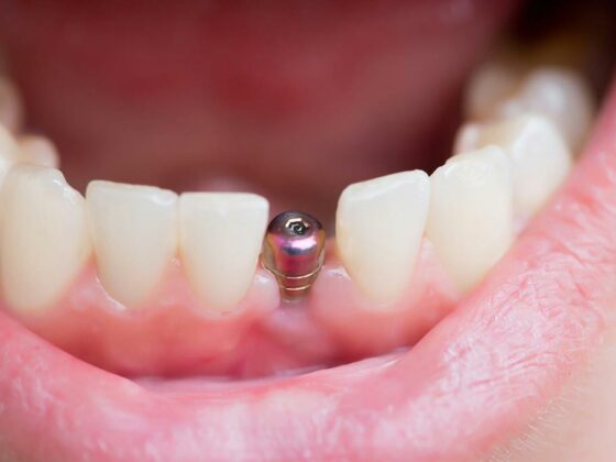 problemas con los implantes dentales