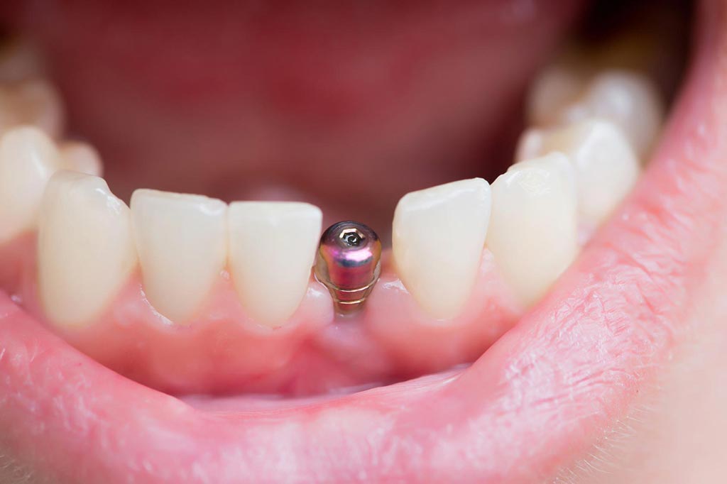¿Problemas con los implantes dentales?